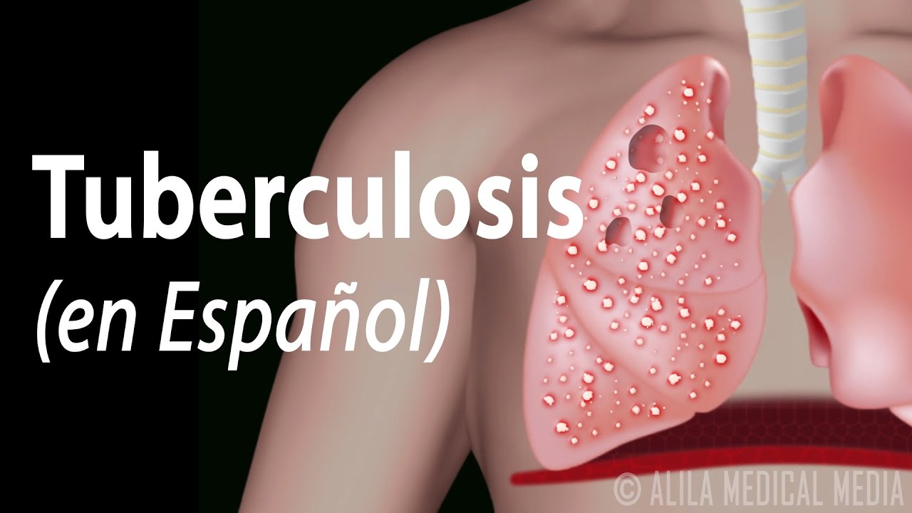 La historia de la tuberculosis: una enfermedad que ha marcado la humanidad